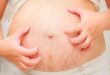 Khá nhiều mẹ bầu phải chung sống với hiện trạng kích ứng, mẩn ngứa trong thời kỳ thời kì mang thai