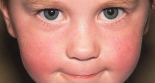 Da có màng đỏ, bị bong vảy là hiện tượng thường thấy khi trẻ mắc Lupus ban đỏ
