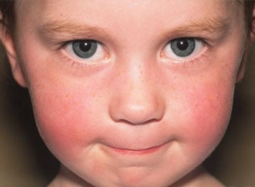 Da có màng đỏ, bị bong vảy là hiện tượng thường thấy khi trẻ mắc Lupus ban đỏ